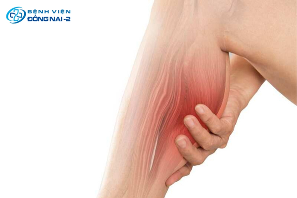 Chuột rút là triệu chứng tụt canxi phổ biến, biểu hiện bằng các cơn co thắt cơ đột ngột