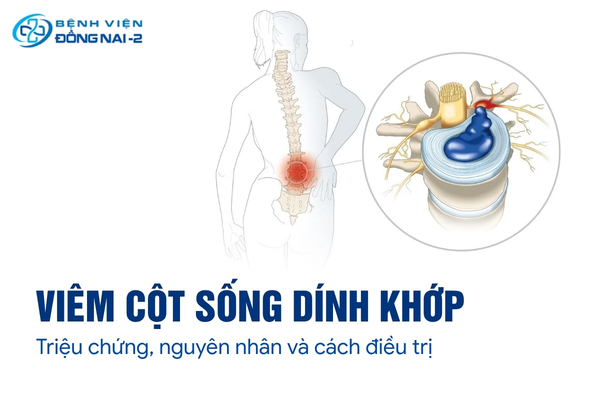Viêm cột sống dính khớp có nguy hiểm không? Xem ngay nguyên nhân và cách điều trị