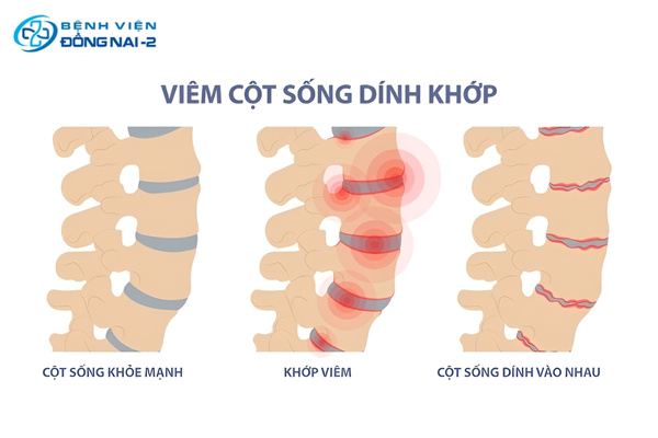 Viêm cột sống dính khớp là tình trạng viêm mạn tính khiến các đốt sống dần hợp nhất