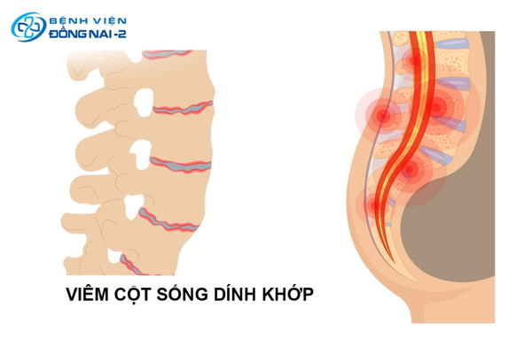 Đau lưng về đêm, cứng khớp và tư thế gù là những triệu chứng cảnh báo viêm cột sống dính khớp