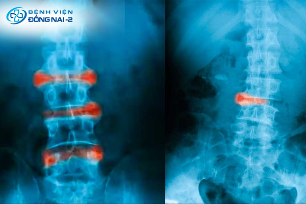 Chụp X-quang giúp phát hiện tổn thương khớp cùng chậu và cột sống ở giai đoạn muộn