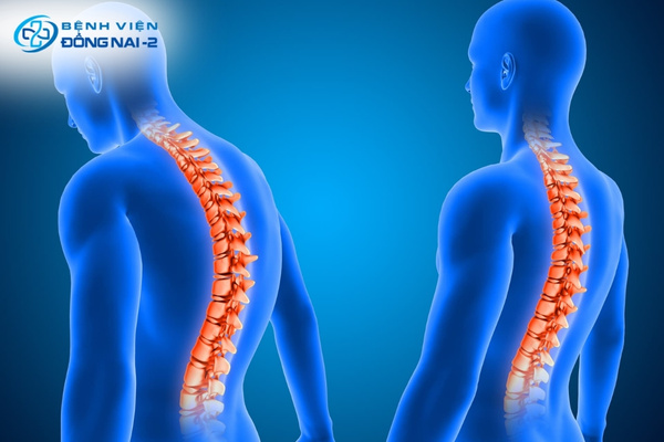 Chế độ ăn uống và sinh hoạt khoa học giúp kiểm soát triệu chứng viêm cột sống dính khớp