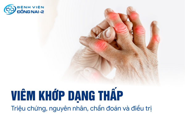 Viêm khớp dạng thấp xảy ra khi hệ miễn dịch tấn công vào màng hoạt dịch