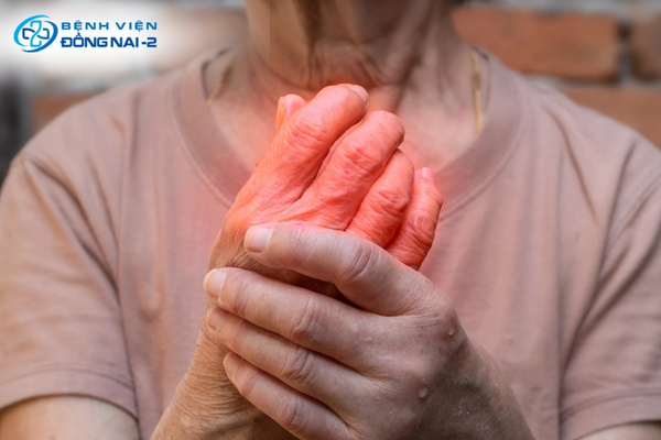 Phụ nữ trung niên là nhóm có nguy cơ mắc viêm khớp dạng thấp cao nhất