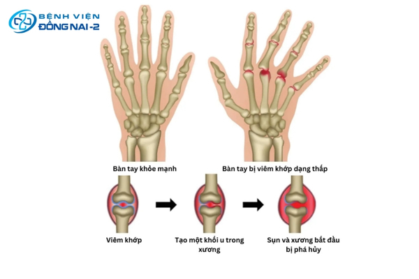 Hình ảnh khớp tay sưng đỏ, biến dạng