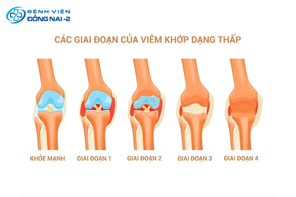 Viêm khớp dạng thấp diễn tiến qua 4 giai đoạn với mức độ tổn thương ngày càng nghiêm trọng