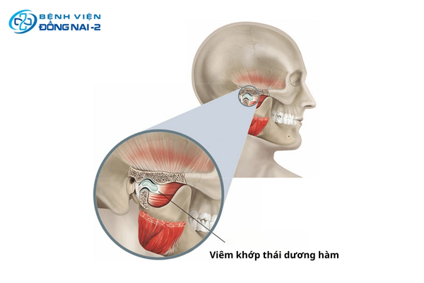 Viêm khớp thái dương hàm do bệnh lý khớp, thói quen xấu, chấn thương hàm và các vấn đề răng miệng